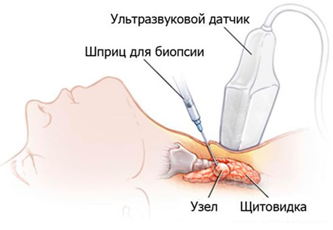 Тонкоигольная аспирационная биопсия (ТАБ) узлов щитовидной железы под контролем УЗИ